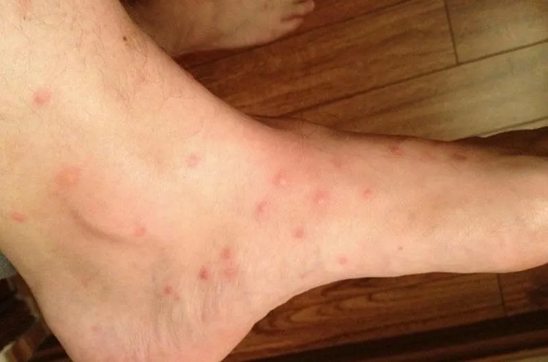 Khi bị bọ chét cắn, thấy ngứa ngáy khó chịu và bị nổi mẩn đỏ trên người và vật nuôi Khi bị bọ chét cắn, thấy ngứa ngáy khó chịu và bị nổi mẩn đỏ trên người và vật nuôi