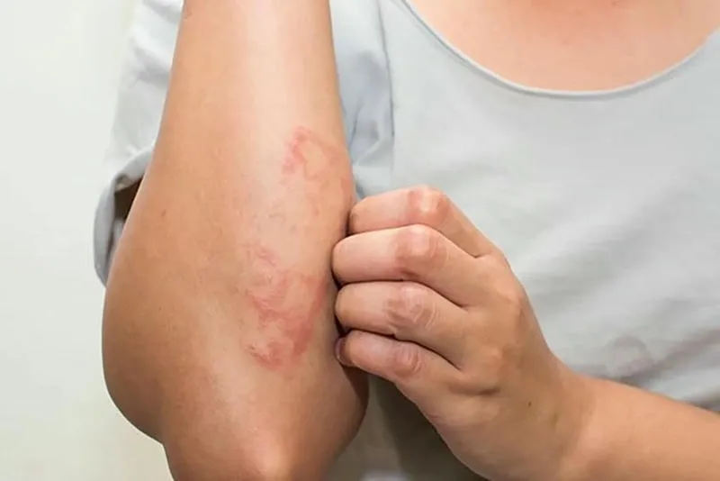 ngứa ngáy dữ dội, nổi mẩn đỏ khi bị bọ chét cắn ngứa ngáy dữ dội, nổi mẩn đỏ khi bị bọ chét cắn