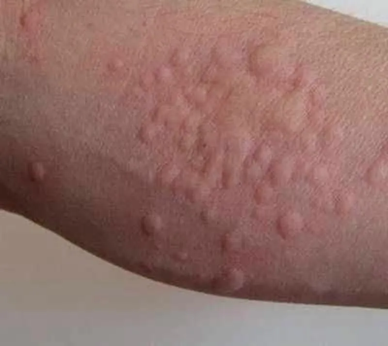 Chấm dứt nỗi ám ảnh bọ chét mèo: Bí quyết hiệu quả Chấm dứt nỗi ám ảnh bọ chét mèo: Bí quyết hiệu quả